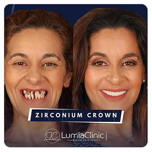 Diş Beyazlatma Önce Sonra